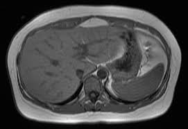 Liver Imaging at Livasa Mohali - Advanced Cirrhosis Assessment
